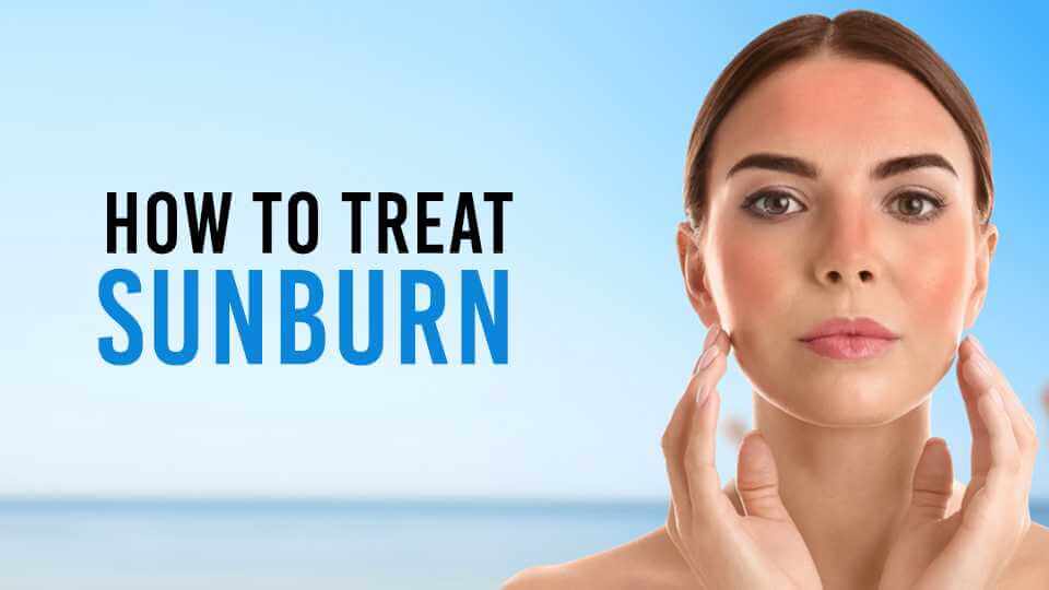How to Treat Sunburn