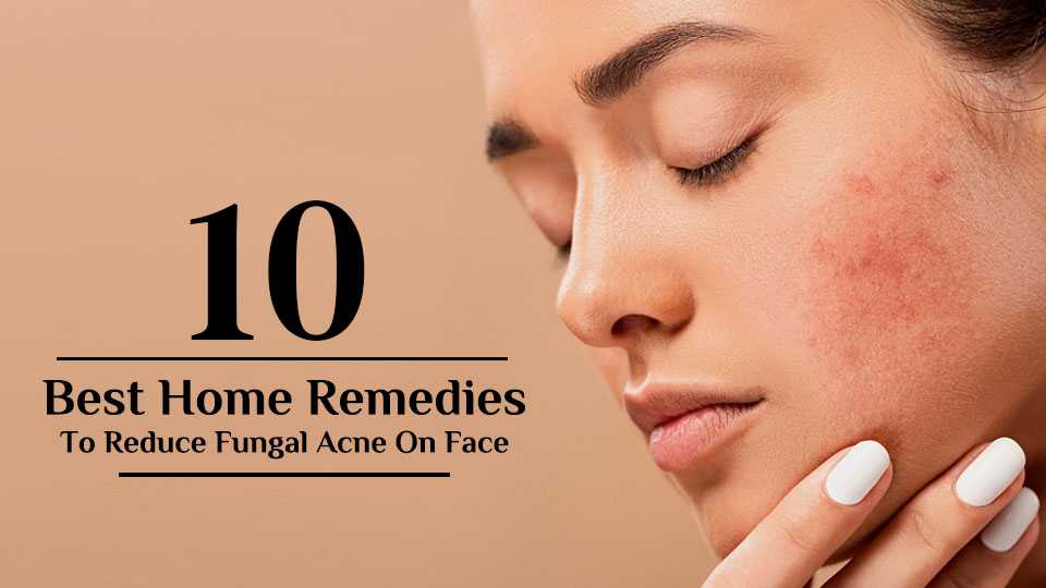 10 Best Home Remedies to Reduce Fungal Acne on Face