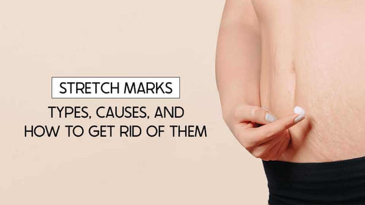 stretch marks types, causes and how to get rid of them