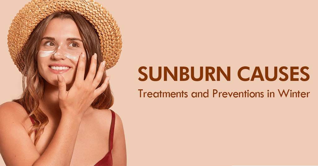 Sunburn Causes, Treatments and Preventions in Winter