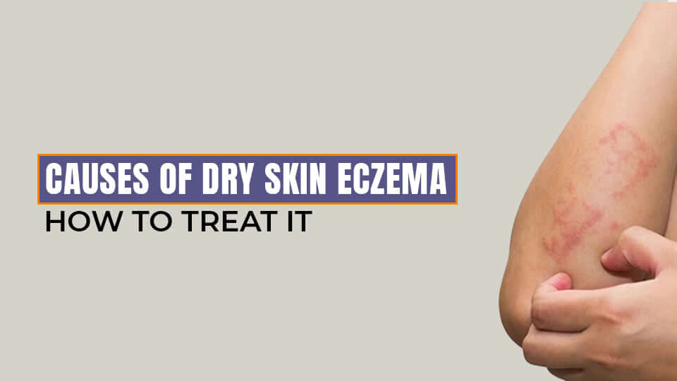 Causes of Dry Skin Eczema and How to Treat It