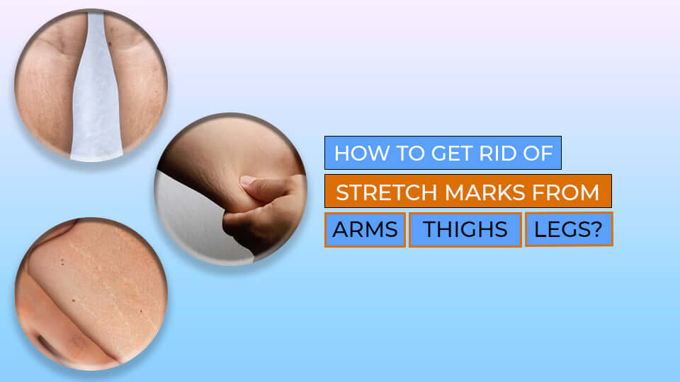 How to get rid of stretch marks on your arms, thighs & legs? Vince