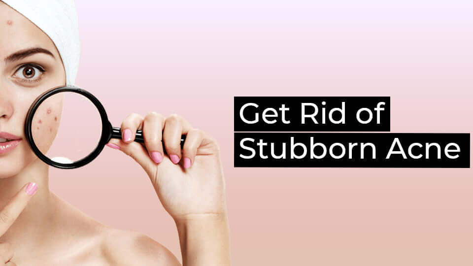 Stubborn Acne Causes & Prevention Tips - Everything You Need To Know