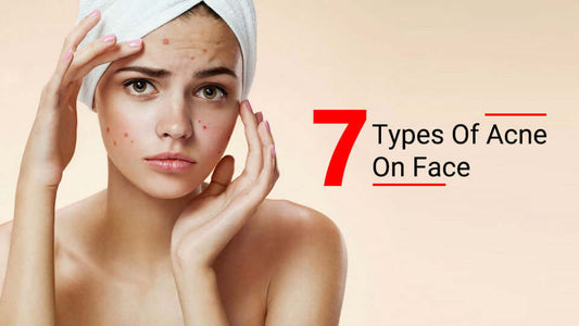 7 types of acne on face