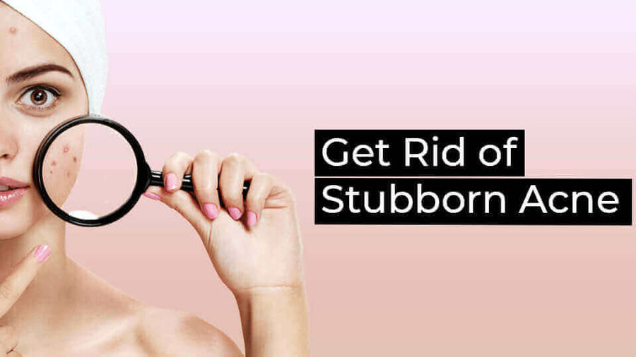 Stubborn Acne Causes & Prevention Tips - Everything You Need To Know