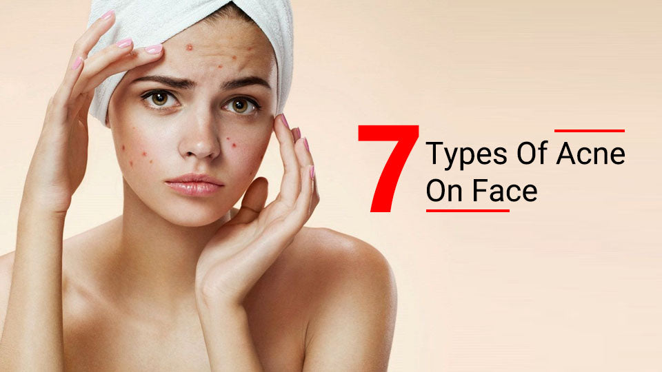 7 Types of Acne on Face