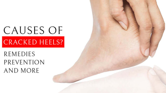 Causes of Cracked Heels and Remedies, Prevention and more