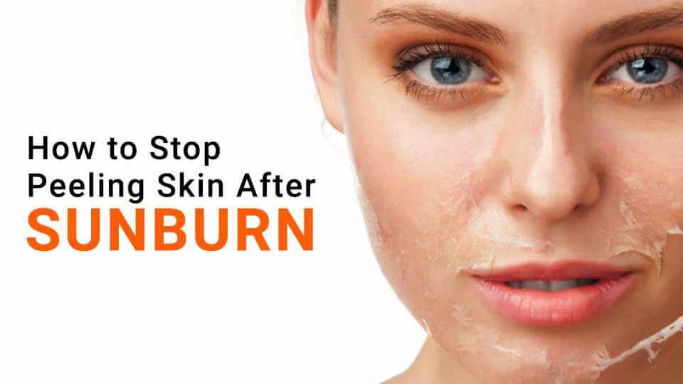 How to Stop Peeling Skin after Sunburn