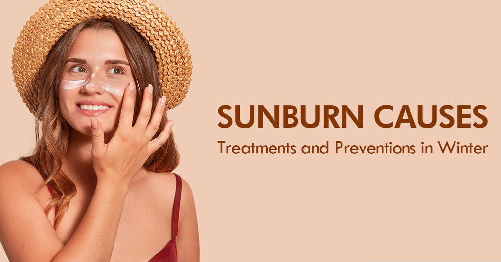 Sunburn Causes, Treatments and Preventions in Winter