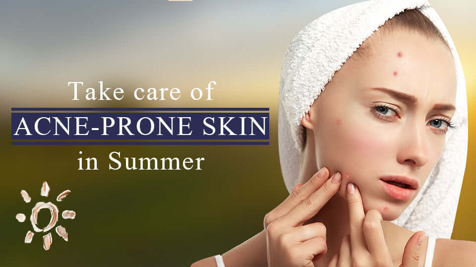 How to take care of acne-prone skin in Summer? An Ultimate guide