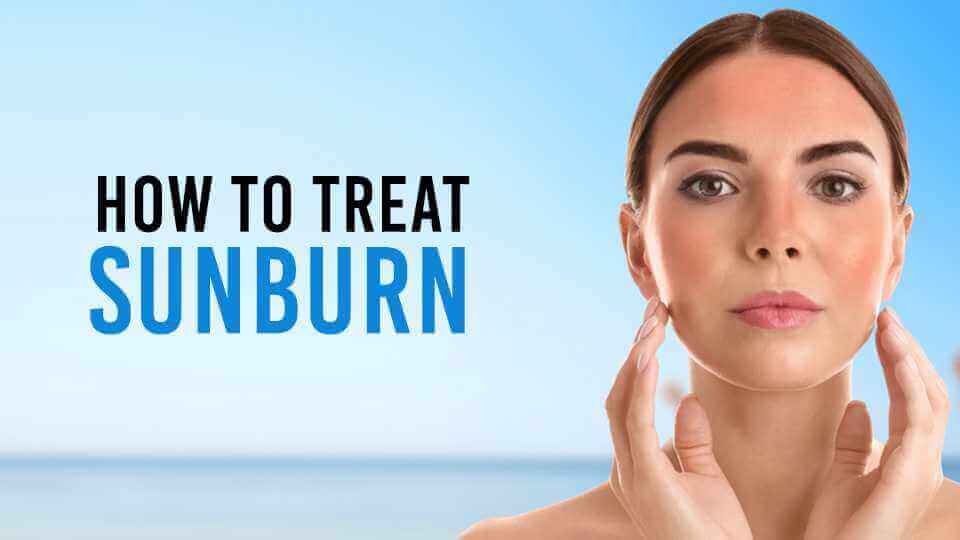 How to Treat Sunburn