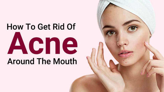 how to get rid of acne around mouth