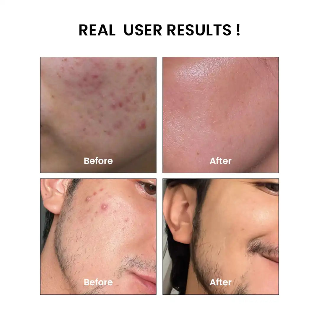 Anti Acne Bundle - Before and After