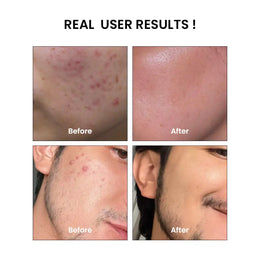 Anti Acne Bundle - Before and After