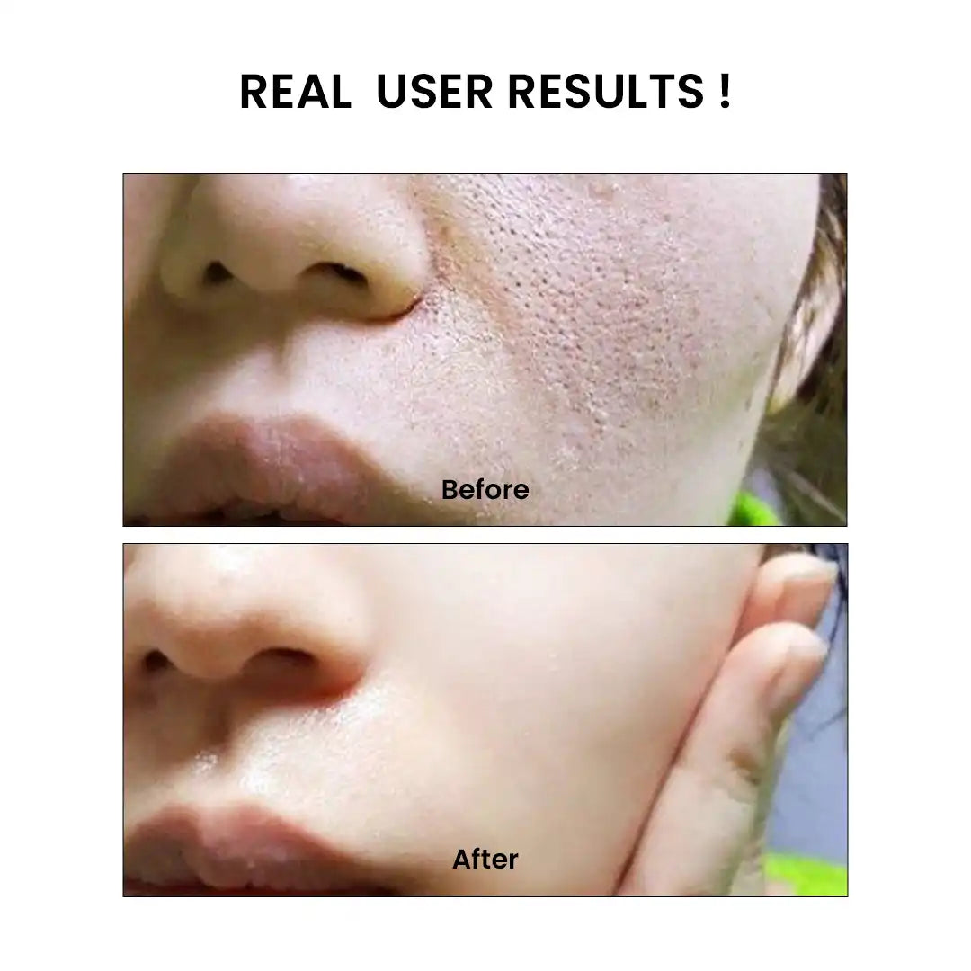 Niacinamide Real Result