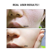 Niacinamide Real Result