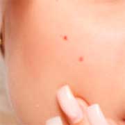 ACNE & BREAKOUTS