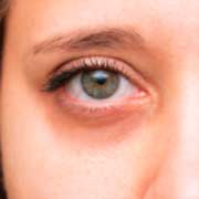 DARK CIRCLES