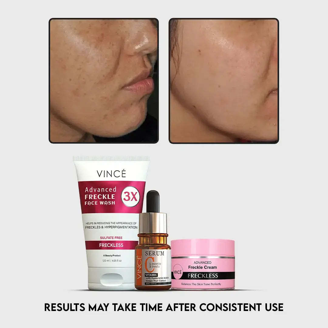 Best Freckle Challenge Kit