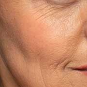 WRINKLES